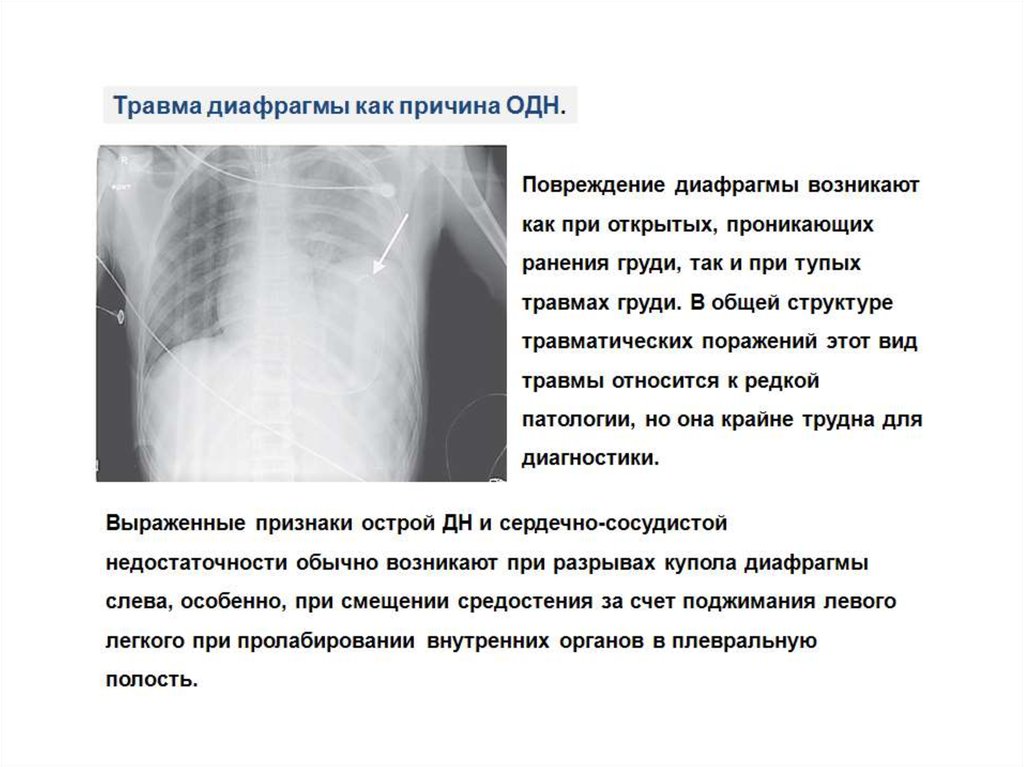 Симптом диафрагмы. Повреждение диафрагмы на рентгене. Разрыв диафрагмы рентген.