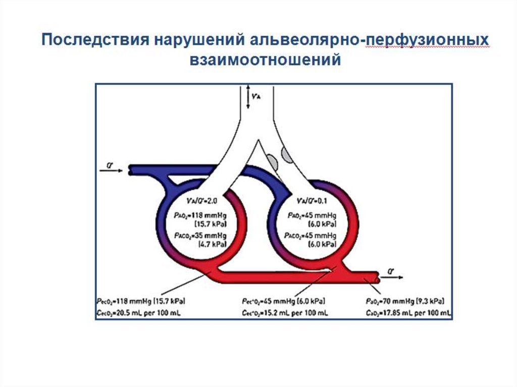 Нижний нарушение. Газообмен физиология. Газообмен в легких физиология. Физиология дыхания газообмен в легких. Нарушений диффузии газов и альвеолярной вентиляции.