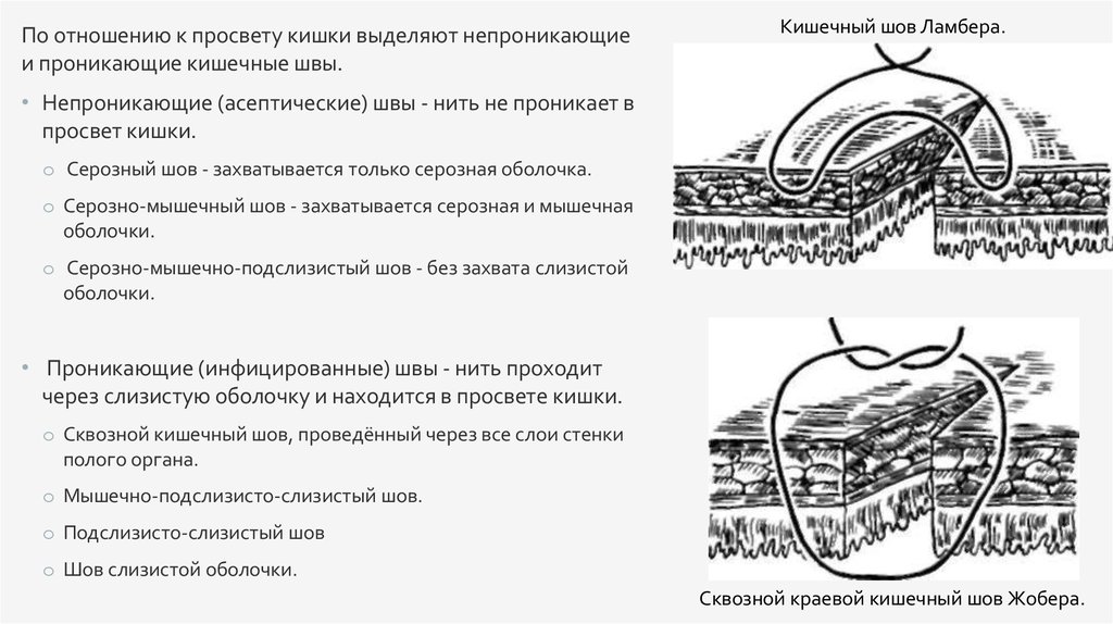 Кишечные швы. Проникающие и непроникающие кишечные швы. Непроникающие кишечные швы техника. Кишечные непроникающие швы топографическая анатомия. Асептические кишечные швы.