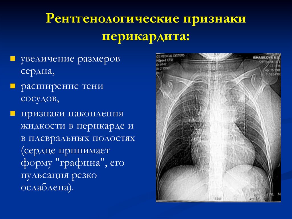 Стромальный рисунок усилен что значит