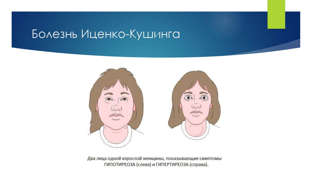 Болезнь Иценко-Кушинга