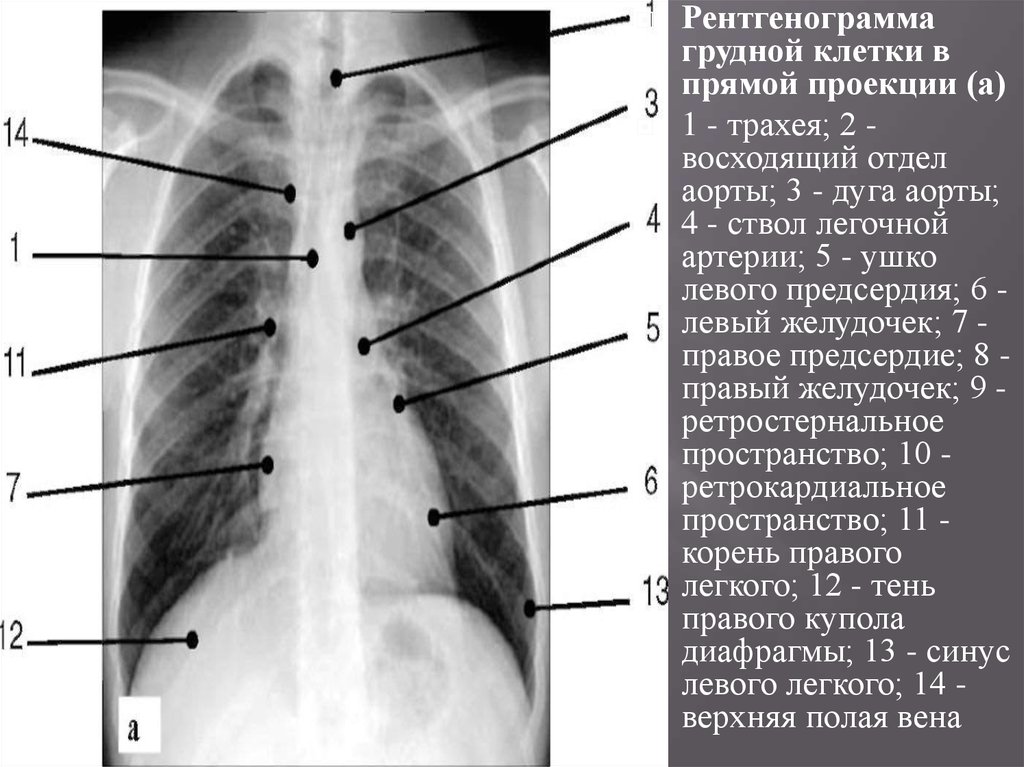 Легкие в двух проекциях. Рентгенограмма грудной клетки в прямой проекции. Рентген анатомия горудной клетки. Рентген грудины в 2 проекциях. Рентгенография органов грудной клетки в прямой проекции.