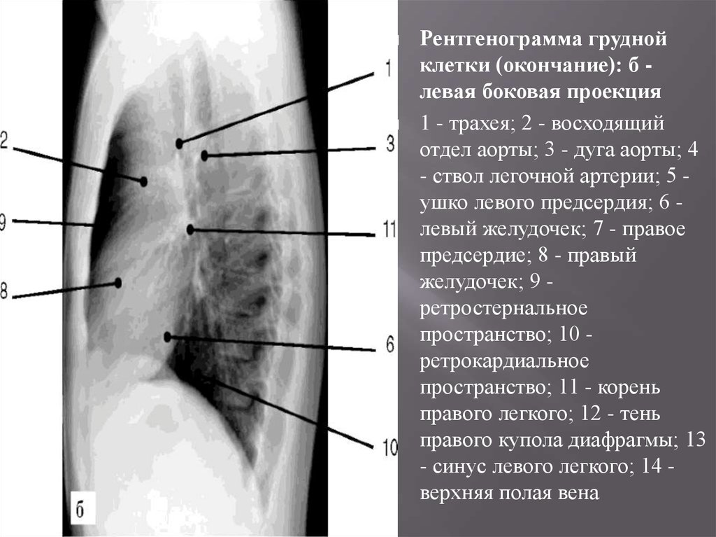 Рентгенограмма грудной клетки. Рентген легких боковая проекция норма. Легкие в боковой проекции на рентгене. Рентген лёгких боковая проекция. Рентгеноанатомия грудины в боковой проекции.