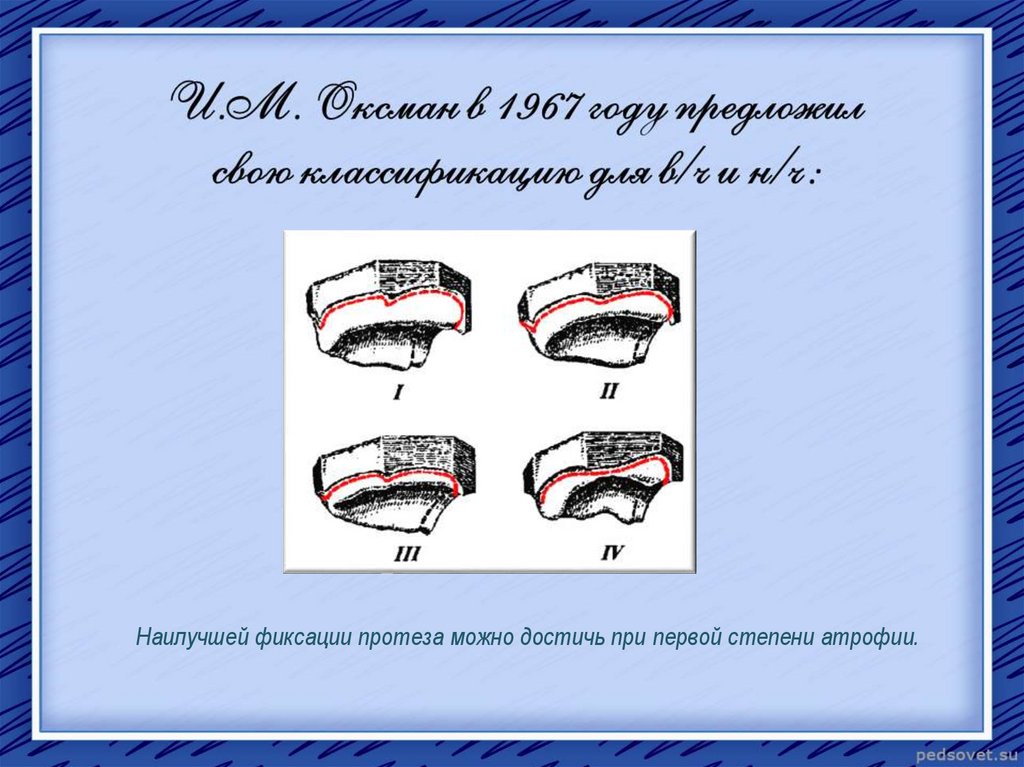 Беззубая челюсть по шредеру. Классификация беззубых челюстей. Классификация Дойникова беззубых челюстей. Классификация атрофии беззубых челюстей по Дойникову. Классификация по Дойникову.