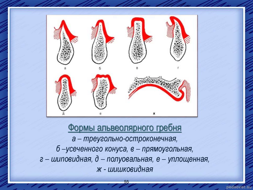 Альвеолярный гребень нижней. Форма альвеолярного гребня по Оксману. Гребень альвеолярного отростка. Формы альвеолярного отростка. Тип атрофии альвеолярного гребня.