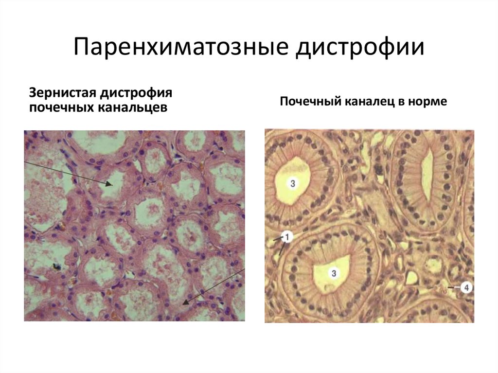 Виды дистрофий с картинками