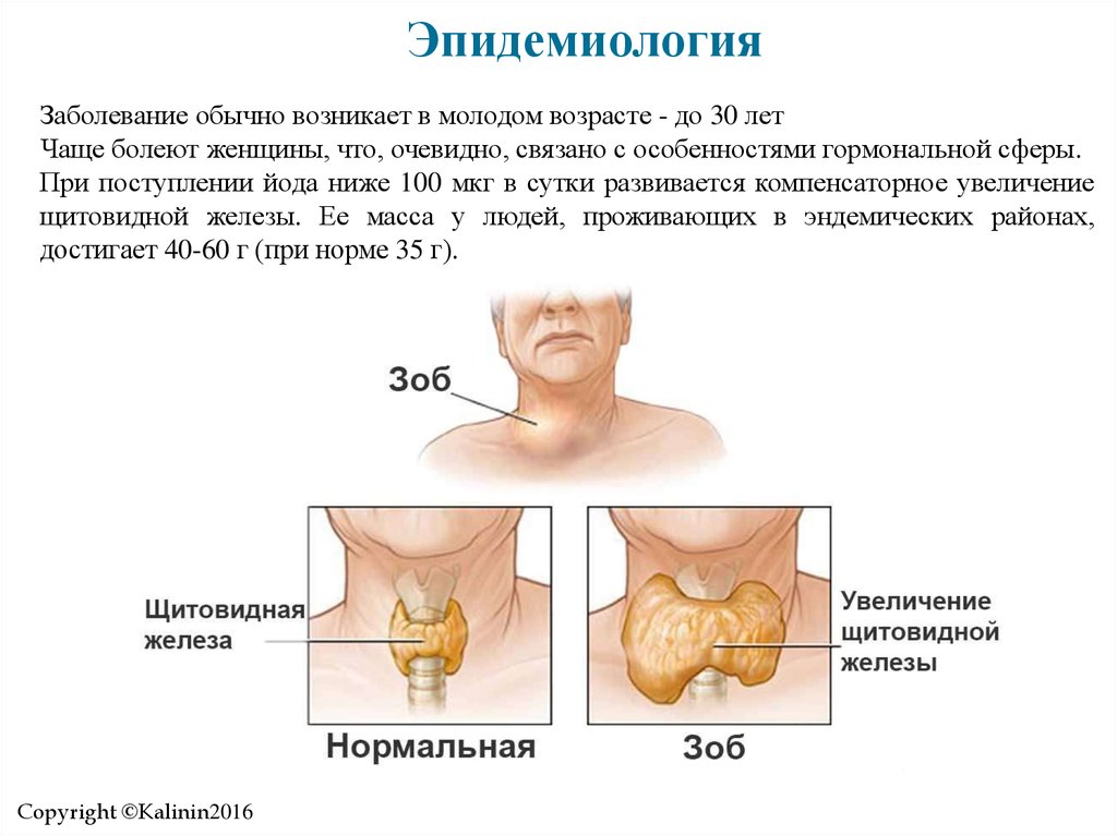 Реферат: Заболевания щитовидной железы. Эндемический зоб