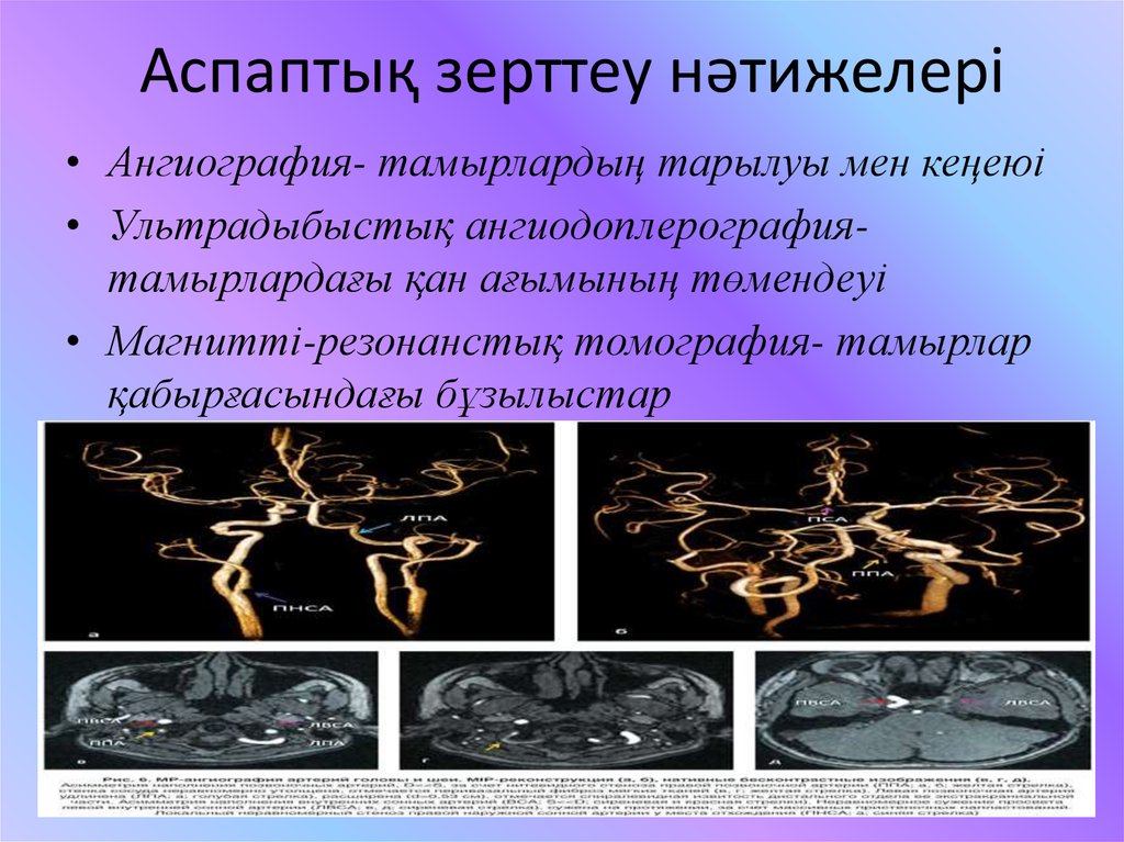 Для болезни такаясу характерно наличие в клинической картине