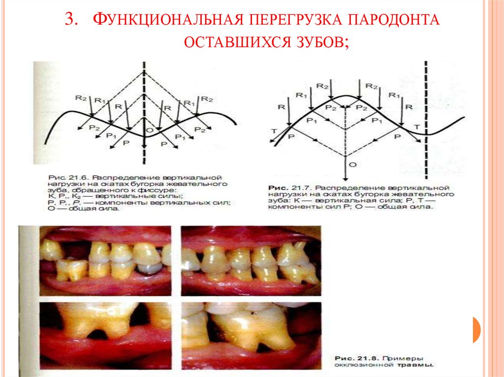 Функциональная перегрузка пародонта оставшихся зубов;