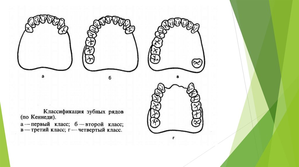 Классификация ряда. Классификация зубных дефектов по Кеннеди с ПОДКЛАССАМИ. Концевые дефекты зубных рядов по Кеннеди. Классификация отсутствия зубов по Кеннеди. Классификация зубных рядов по Кеннеди и Гаврилову.
