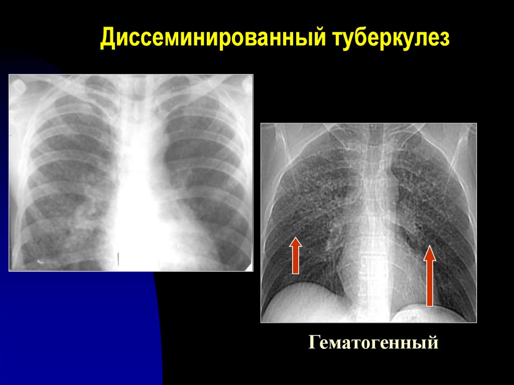 Острый диссеминированный туберкулез. Острый диссеминированный туберкулез рентген. Подострый диссиминированный туберкулёз рентген. Подострый диссеминированный туберкулез рентген. Гематогенно диссеминированный туберкулез рентген.
