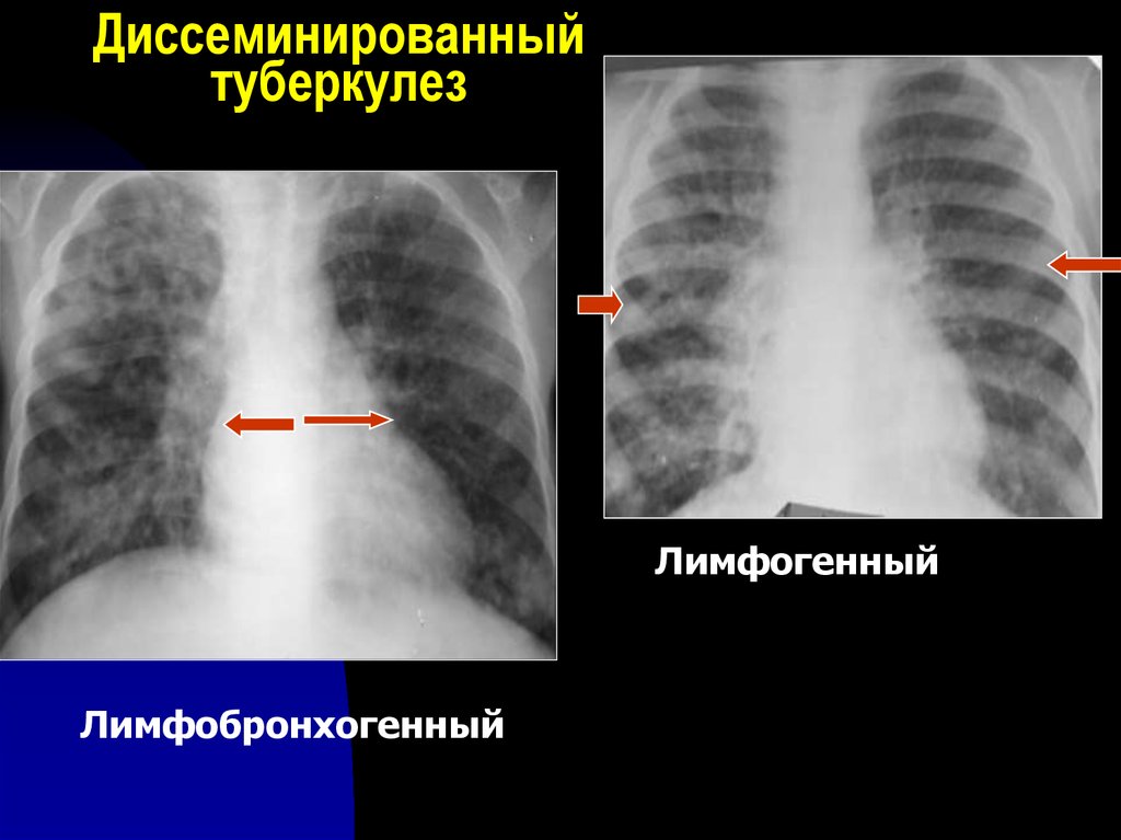 Лимфогенный туберкулез. Лимфогенно диссеминированный туберкулез рентген. Подострый диссеминированный туберкулез рентген. Лимфогенный диссеминированный туберкулез. Лимфогенно диссеминированный туберкулез кт.