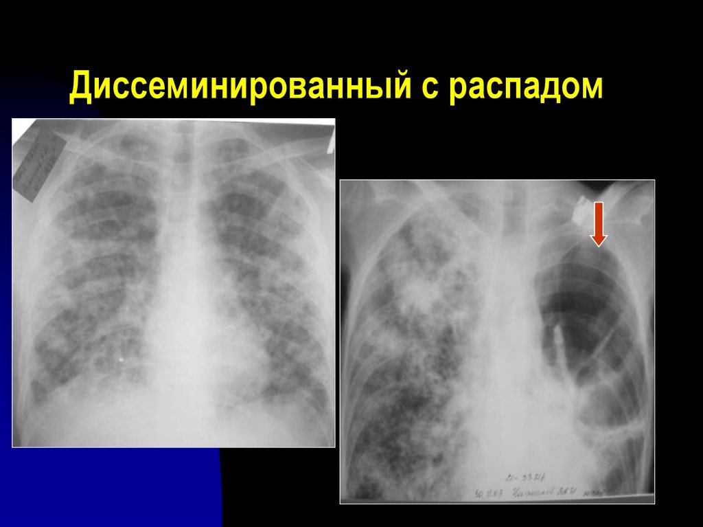 Фаза распада легких. Подострый диссеминированный туберкулез рентген. Хронический диссеминированный туберкулез рентген. Диссеминированный инфильтративный туберкулез. Подострый диссиминированный туберкулёз рентген.