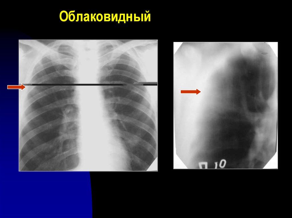 Перисциссурит рентген картина