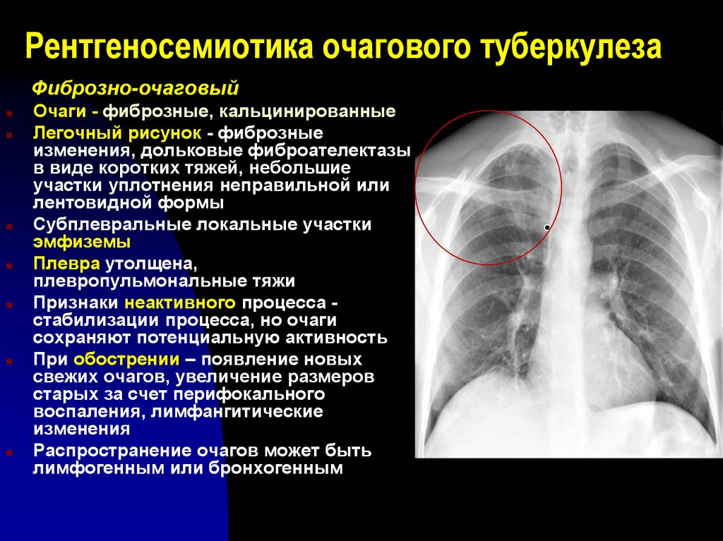 Очаг в верхней доле правого легкого. Рентгенологические признаки фиброзно-очагового туберкулеза. Рентгенодиагностика туберкулеза. Туберкулез органов дыхания. Очаговый туберкулез диагноз.