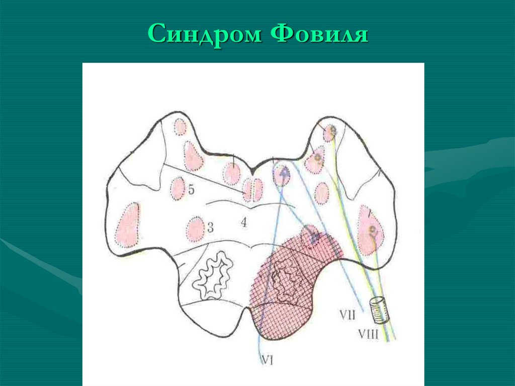 Синдром фовилля. Альтернирующий синдром Фовилля. Синдром Фовилля неврология. Синдром Фовилля симптомы.