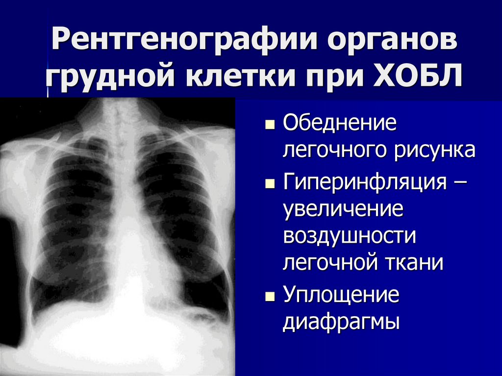 Рентгенографии органов грудной клетки при ХОБЛ