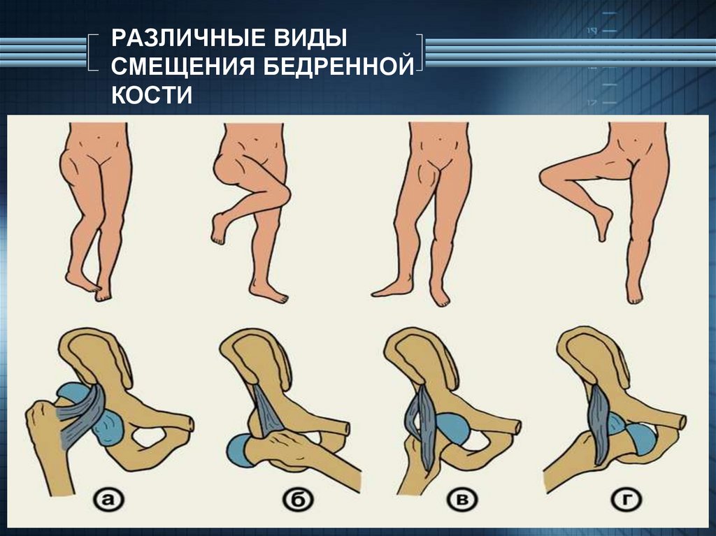 Вывих бедра. Задневерхний вывих бедра. Задневерхний вывих тазобедренного сустава. Задний верхний вывих бедра. Осложнения вывиха бедра.