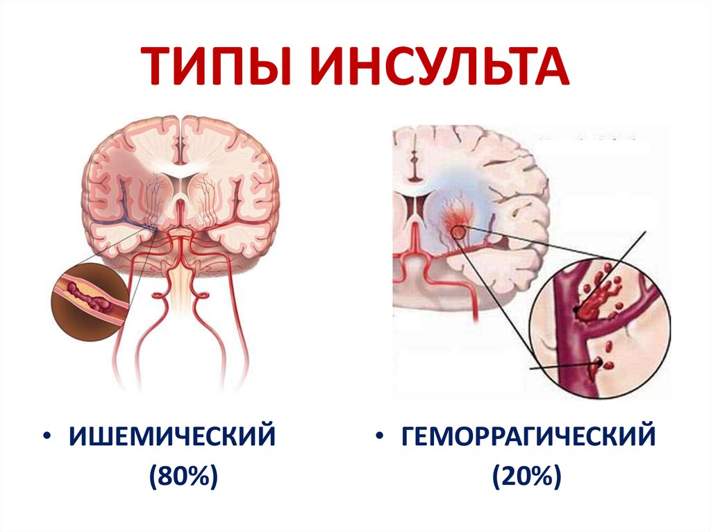 Геморрагический инсульт презентация