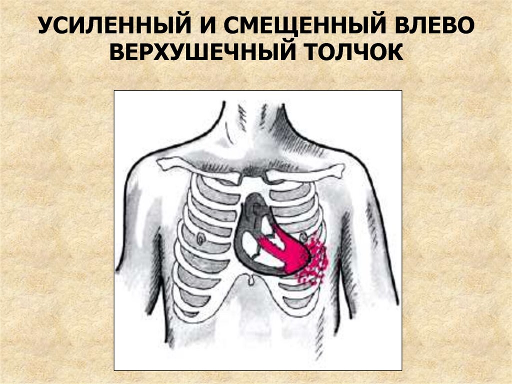 Сердце лево. Смещение верхушечного толчка. Смещение верхушечного толчка влево. Верхушечный толчок сердца.