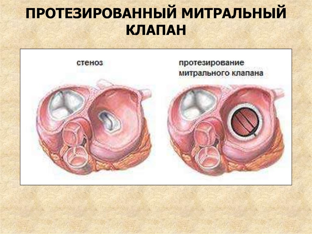 Митральный клапан после операции. Протез митрального клапана сердца. Стеноз митрального клапана хирургия. Митральный клапан сердца механический протез. Митральный клапан сердца кт.