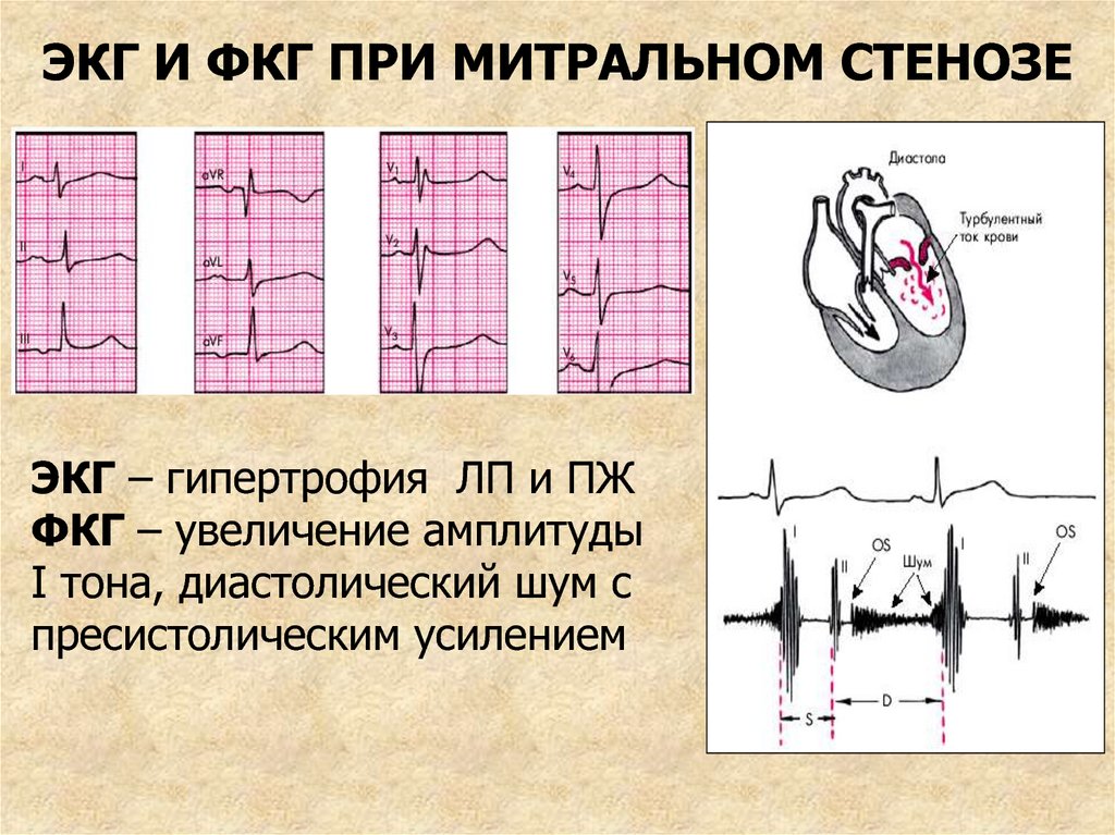 Аускультативная картина при митральном стенозе сердца включает на верхушке