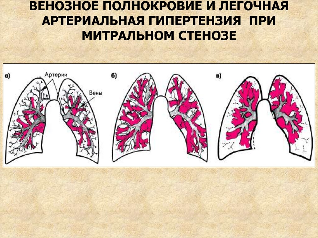 Сосудистый рисунок легких