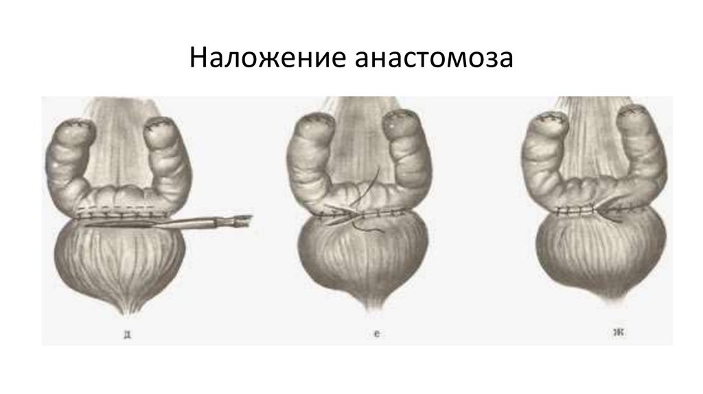 Тонкая кишка пластика