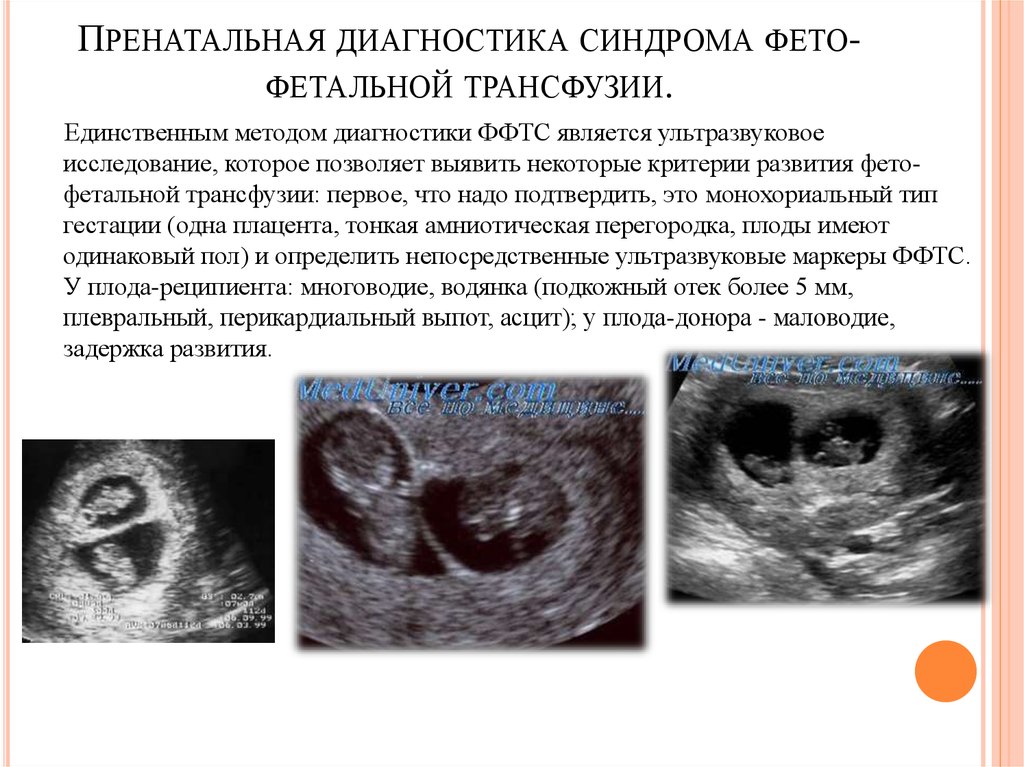 Фето фетальный трансфузионный синдром. Монохориальная двойня фето фетальный синдром. Монохориальная беременность УЗИ. Ультразвуковыми признаками синдрома фето-фетальной гемотрансфузии. УЗИ критерии многоплодной беременности.