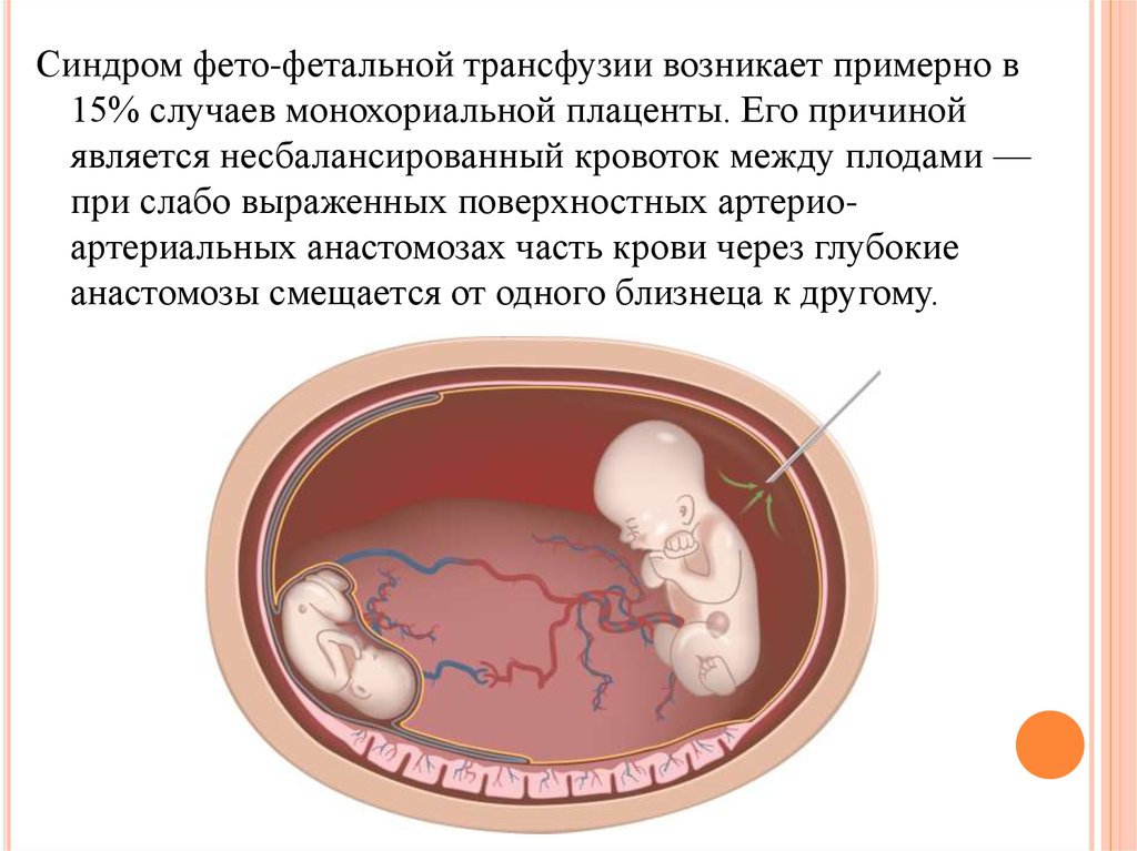 Фето фетальный трансфузионный синдром