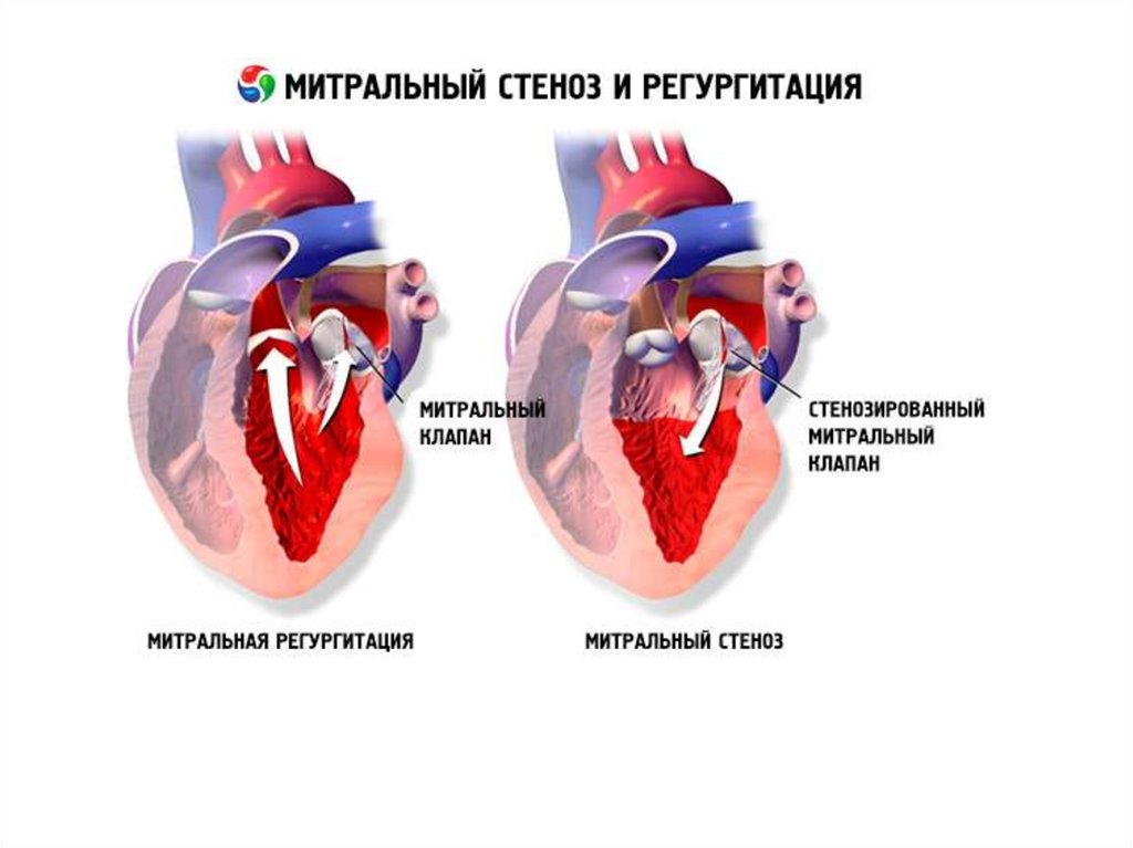 Порок сердца и сердечная недостаточность