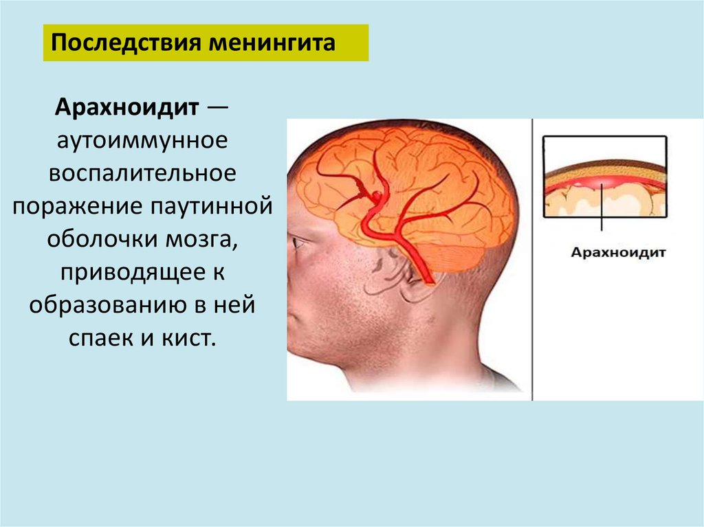 Воспаление головного мозга латынь. Менингит воспаление мозговых оболочек. Очаг поражения менингита. Воспаление головного мозга симптомы менингит.