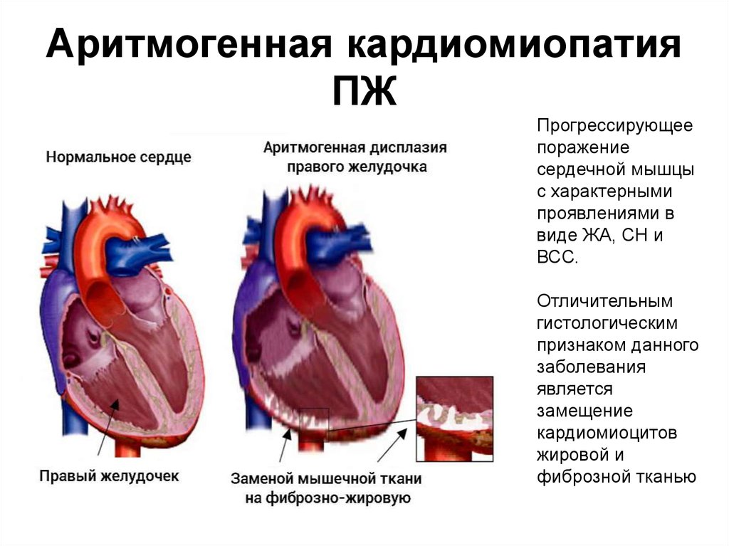 Кардиопатия. Аритмогенная правожелудочковая дисплазия (кардиомиопатия). Аритмогенная дисплазия правого желудочка клинические рекомендации. Патогенез аритмогенной правожелудочковой кардиомиопатии. Аритмогенная дисплазия правого желудочка этиология.