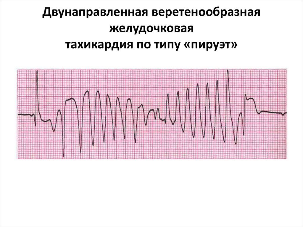 Желудочковый пируэт. Желудочковая тахикардия типа Пируэт. Веретенообразная желудочковая тахикардия ЭКГ. Полиморфная желудочковая тахикардия типа Пируэт на ЭКГ. Желудочковая пароксизмальная тахикардия типа «Пируэт».