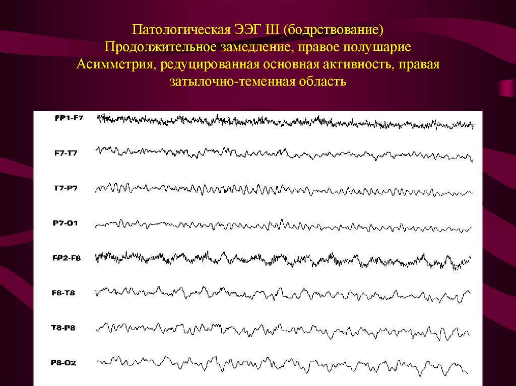 Ээг 6. Эпилептиформные паттерны на ЭЭГ. Региональная эпилептиформная активность ЭЭГ. Эпилепсия на ЭЭГ. Ритм ЭЭГ эпилепсия.