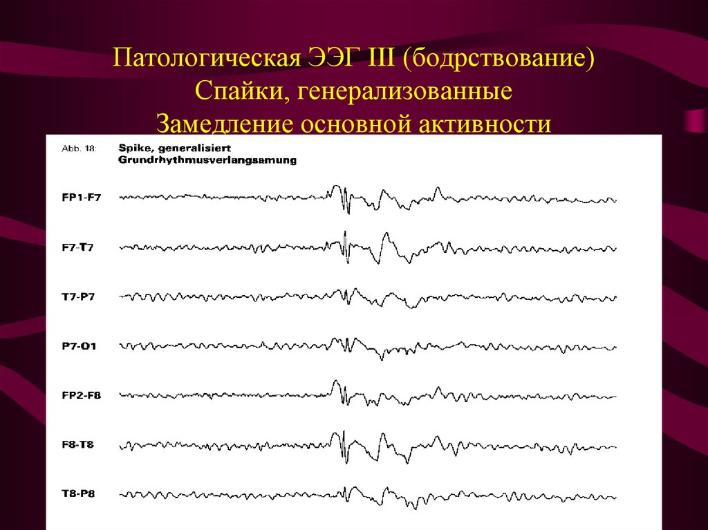 Спайки на ээг. Эпилептические паттерны на ЭЭГ. Комплекс Спайк медленная волна на ЭЭГ. Патологическая активность на ЭЭГ что это. Спайк волновая активность на ЭЭГ.