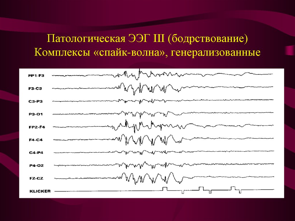 Острые волны на ээг. ЭЭГ эпилепсия пик-волна. Комплекс Спайк медленная волна на ЭЭГ. Эпилептиформная активность на ЭЭГ. Спайк волновая активность на ЭЭГ.
