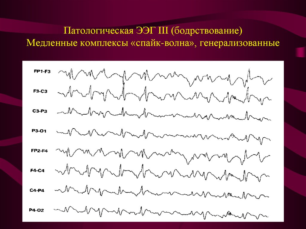 Ээг показывает эпилепсию. Пароксизмальная активность на ЭЭГ. Эпилептиформная активность на ЭЭГ. Патологическая ЭЭГ бодрствование. Патологические ритмы ЭЭГ при эпилепсии.