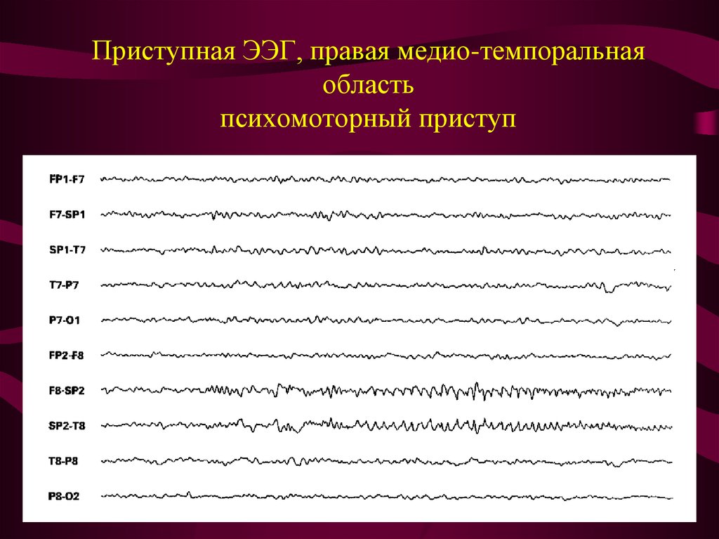 Индекс эпилептиформной активности. Эпилептиформная активность на ЭЭГ. Миоклонический приступ на ЭЭГ. Эпилептиформные разряды на ЭЭГ. Фокальная эпилепсия на ЭЭГ.