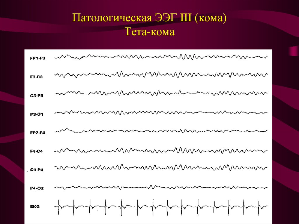 Ритмы ээг. ЭЭГ волны патологические. ЭЭГ патологический тета ритм. Тета активность на ЭЭГ. Тета волны на ЭЭГ.