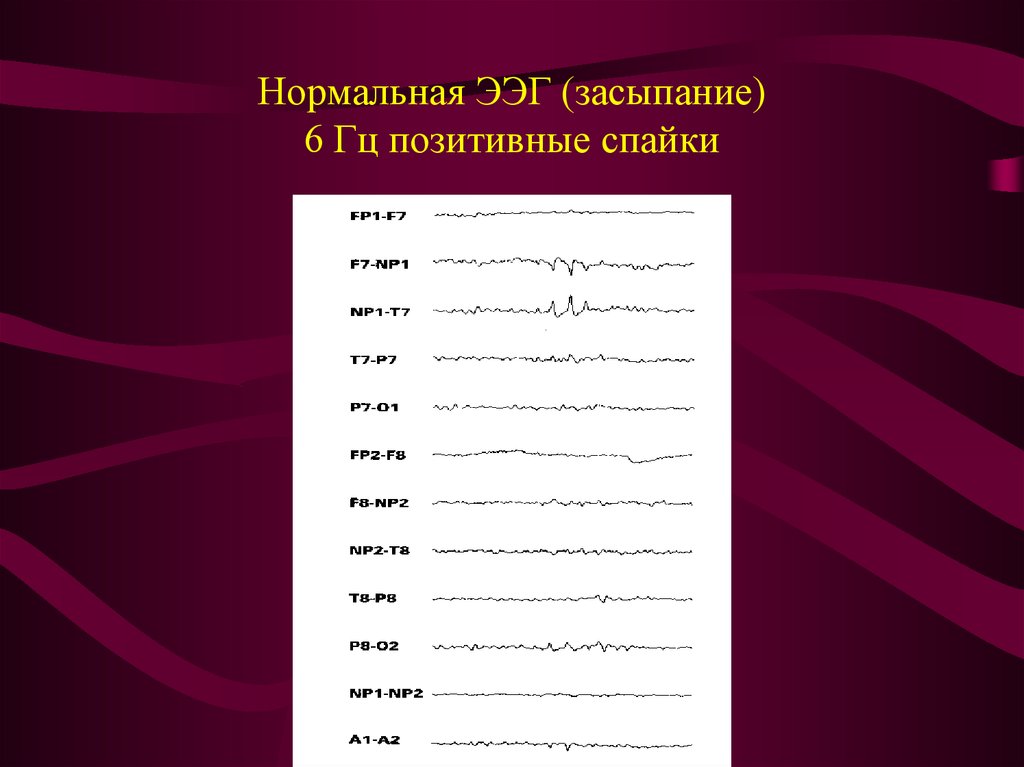 Нормальная ээг у взрослого фото