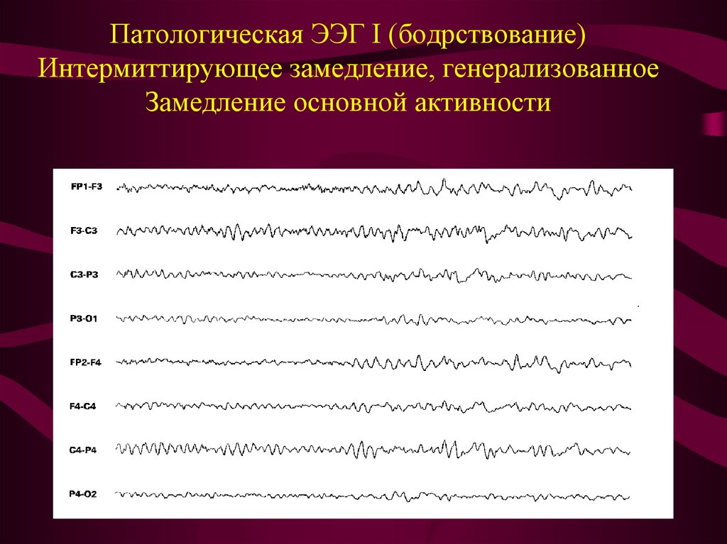 Ээг показывает эпилепсию. Региональная эпилептиформная активность ЭЭГ. ЭЭГ при эпилепсии расшифровка у детей. ЭЭГ эпилепсия расшифровка. Фокальная эпилепсия на ЭЭГ.