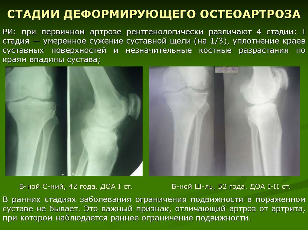 Диагноз доа суставов. Деформирующий остеоартроз коленного сустава 2 стадии рентген. Остеоартроз коленного сустава степени рентген. Доа коленного сустава на рентгене.