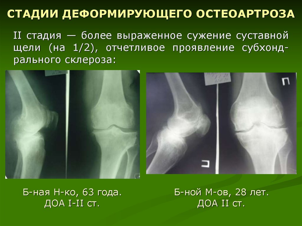 Диагноз доа суставов. Доа коленного сустава на рентгене. Деформирующий артроз коленного сустава рентген степени. Деформирующий остеоартроз коленного сустава степени рентген.