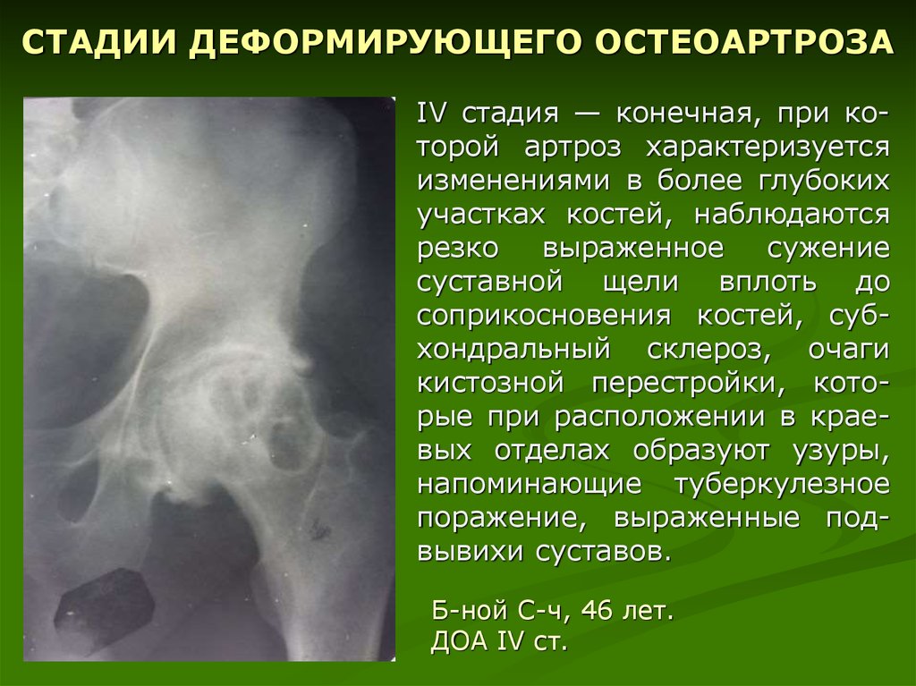 Остеоартроз что это такое как лечить. Деформирующий остеоартроз степени рентген. .Деформирующий остеоартрит остеоартроз.