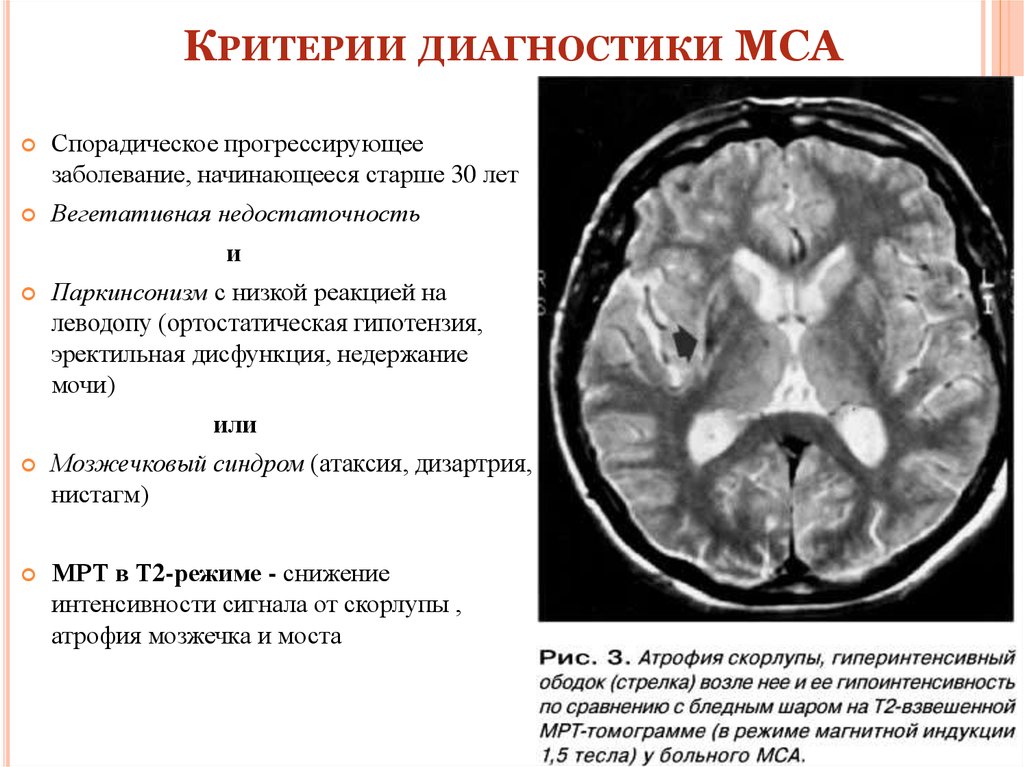 Признаки атрофии головного мозга. Мультисистемная атрофия мрт. Множественная системная атрофия. Атрофия головного мозга мрт. Мультисистемная атрофия головного мозга.