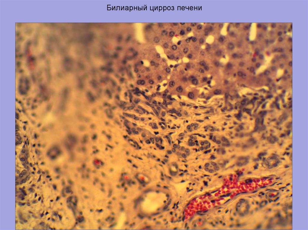 Билиарный цирроз. Билиарный цирроз печени препарат. Юиллипонвй цтроз песени. Вторичный билиарный цирроз гистология. Билиарный цирроз печени микроскопическая картина.