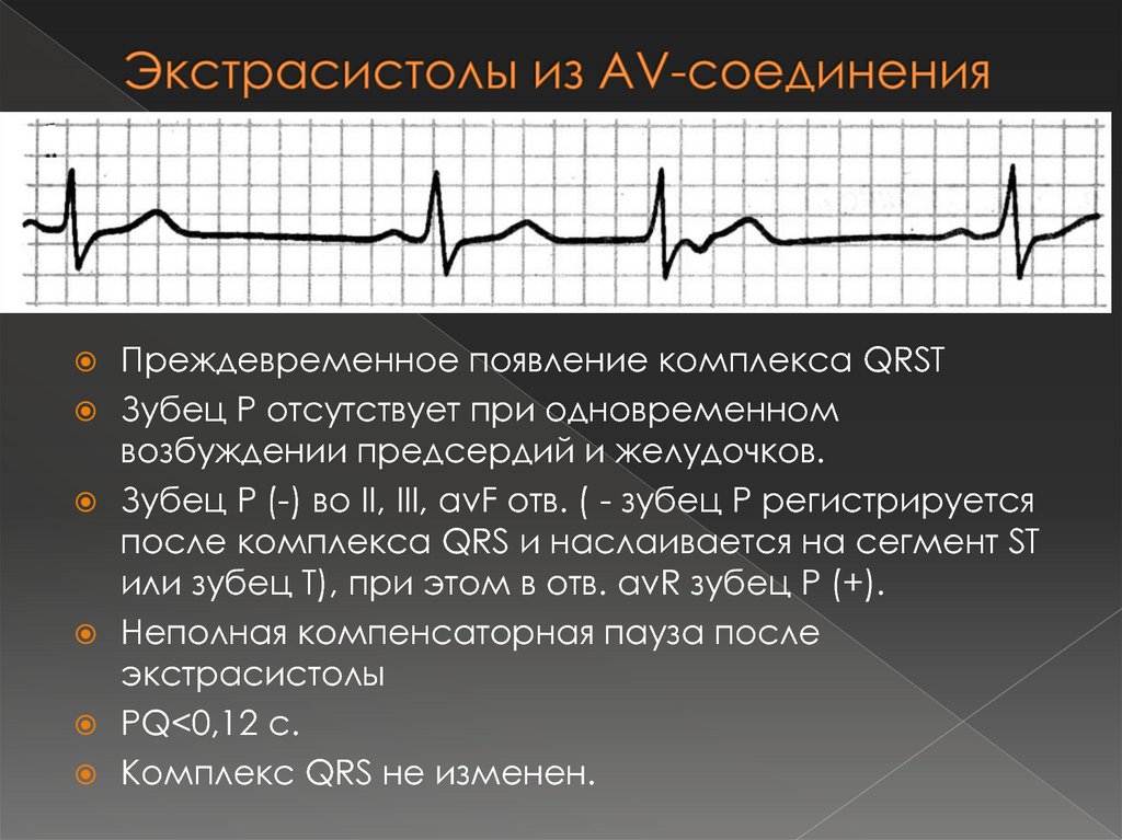 Экстрасистолы лежа