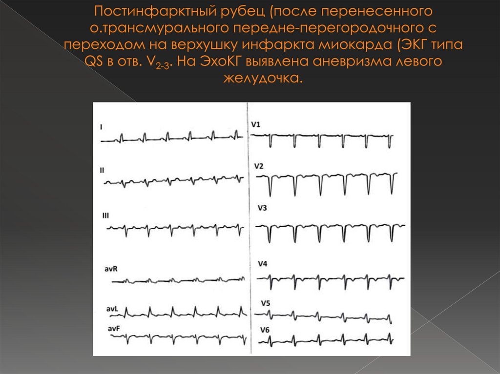 Постинфарктный рубец (после перенесенного о.трансмурального передне-перегородочного с переходом на верхушку инфаркта миокарда