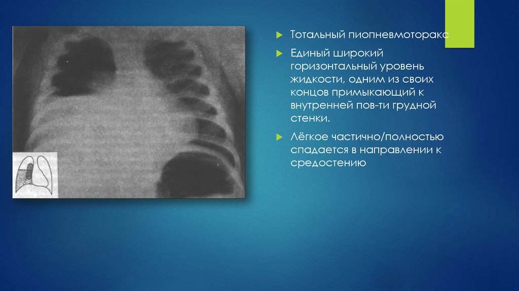 Реферат: Острая эмпиема плевры и пиопневмоторакс